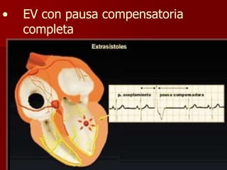 • EV con pausa compensatoria
completa
 