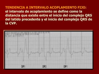 TENDENCIA A INTERVALO ACOPLAMIENTO FIJO:
el intervalo de acoplamiento se define como la
distancia que existe entre el inicio del complejo QRS
del latido precedente y el inicio del complejo QRS de
la CVP.
 