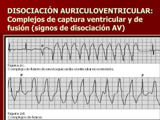 DISOCIACIÓN AURICULOVENTRICULAR:
Complejos de captura ventricular y de
fusión (signos de disociación AV)
 