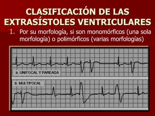 CLASIFICACIÓN DE LAS
EXTRASÍSTOLES VENTRICULARES
1. Por su morfología, si son monomórficos (una sola
morfología) o polimórficos (varias morfologías)
 