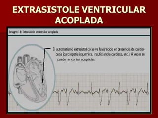 EXTRASISTOLE VENTRICULAR
ACOPLADA
 
