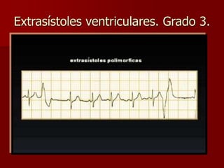 Extrasístoles ventriculares. Grado 3.
 