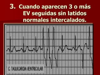 3. Cuando aparecen 3 o más
EV seguidas sin latidos
normales intercalados.
 