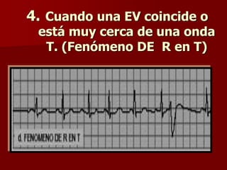 4. Cuando una EV coincide o
está muy cerca de una onda
T. (Fenómeno DE R en T)
 
