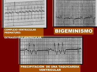 BIGEMINISMO
PRECIPITACIÓN DE UNA TAQUICARDIA
VENTRICULAR
COMPLEJO VENTRICULAR
PREMATURO:
EXTRASÍSTOLE VENTRICULAR.
 