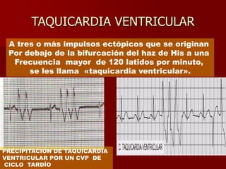 TAQUICARDIA VENTRICULAR
A tres o más impulsos ectópicos que se originan
Por debajo de la bifurcación del haz de His a una
Frecuencia mayor de 120 latidos por minuto,
se les llama «taquicardia ventricular».
PRECIPITACION DE TAQUICARDIA
VENTRICULAR POR UN CVP DE
CICLO TARDÍO
 