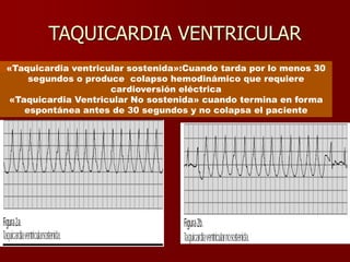 TAQUICARDIA VENTRICULAR
«Taquicardia ventricular sostenida»:Cuando tarda por lo menos 30
segundos o produce colapso hemodinámico que requiere
cardioversión eléctrica
«Taquicardia Ventricular No sostenida» cuando termina en forma
espontánea antes de 30 segundos y no colapsa el paciente
 