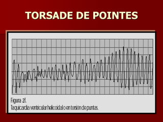 TORSADE DE POINTES
 