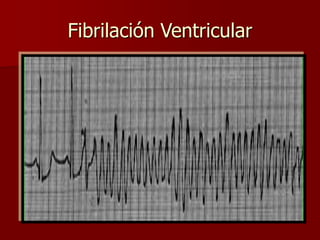 Fibrilación Ventricular
 