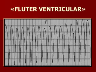 «FLUTER VENTRICULAR»
 
