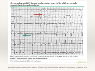 Manolis AS. Supraventricular premature beats. En: UpToDate, Post TW (Ed), UpToDate, Waltham, MA. (Consultado el 14 de julio de 2015).
 