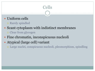 Cells
 Uniform cells
 Rarely spindled
 Scant cytoplasm with indistinct membranes
 Clear from glycogen
 Fine chromatin, inconspicuous nucleoli
 Atypical (large cell) variant
 Large nuclei, conspicuous nucleoli, pleomorphism, spindling
 