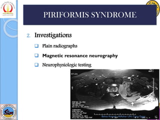 2. Investigations
❑ Plain radiographs
❑ Magnetic resonance neurography
❑ Neurophysiologic testing
PIRIFORMIS SYNDROME
Bahaa Kornah -AlAzhar UN. Cairo Egypt
 