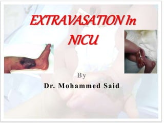 EXTRAVASATIONIn
NICU
By
Dr. Mohammed Said
 