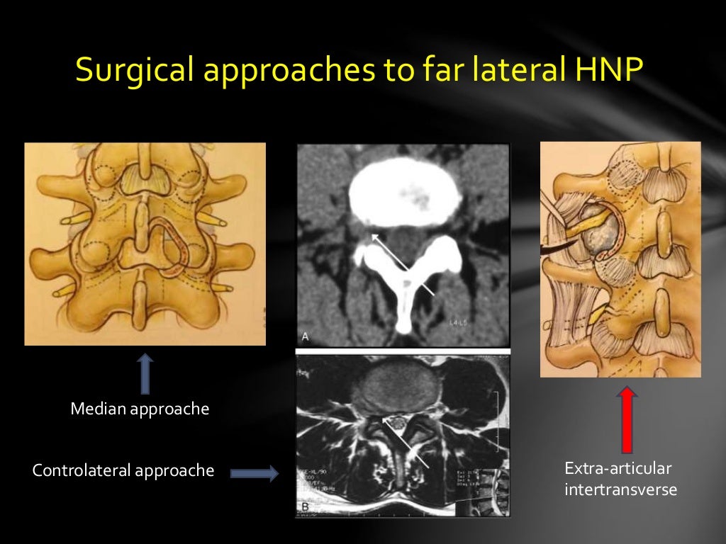 Extreme Lateral Disc Herniation Causing Lumbar And Radicular Pain