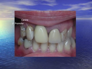 Canine 1 st  Premolar 
