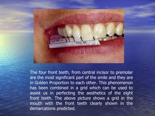 The four front teeth, from central incisor to premolar are the most significant part of the smile and they are in Golden Proportion to each other. This phenomenon has been combined in a grid which can be used to assist us in perfecting the aesthetics of the eight front teeth. The above picture shows a grid in the mouth with the front teeth clearly shown in the demarcations predicted. 