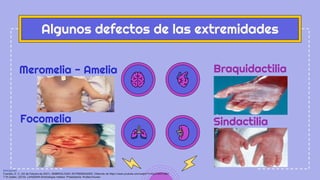 Focomelia Rx Extremidades_Embriologia.pdf lagman 15ba edición | PDF