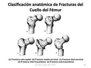 Clasificación anatómica de Fracturas del
            Cuello del Fémur




(a) Fractura sub-capital (b) Fractura medio-cervical (c) Fractura basi-cervical
          (d) Fractura inter-trocantérea (e) Fractura sub-trocantérea
                            Dr. José L. Torres, M.S., Ph.D.                       28
 