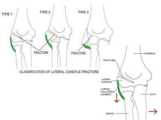 Extremity trauma | PPTX