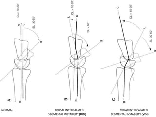 Distal Inertia Extremity trauma | PPTX