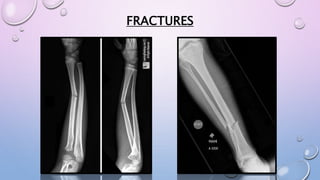 FRACTURES
 