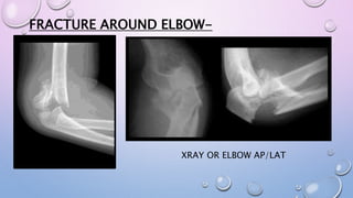 FRACTURE AROUND ELBOW-
XRAY OR ELBOW AP/LAT
 