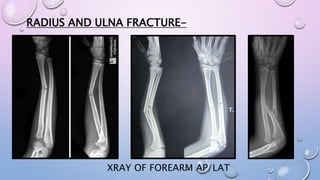 RADIUS AND ULNA FRACTURE-
XRAY OF FOREARM AP/LAT
 