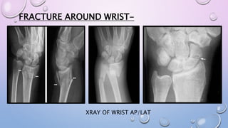 FRACTURE AROUND WRIST-
XRAY OF WRIST AP/LAT
 