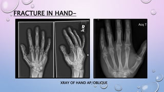 FRACTURE IN HAND-
XRAY OF HAND AP/OBLIQUE
 