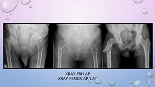 XRAY PBH AP
XRAY FEMUR AP/LAT
 