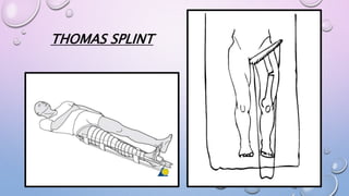 THOMAS SPLINT
 
