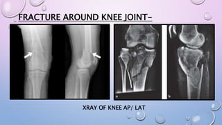 FRACTURE AROUND KNEE JOINT-
XRAY OF KNEE AP/ LAT
 