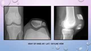 XRAY OF KNEE AP/ LAT/ SKYLINE VIEW
 