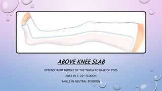 ABOVE KNEE SLAB
EXTEND FROM MIDDLE OF THE THIGH TO BASE OF TOES
KNEE IN 5-20* FLEXION
ANKLE IN NEUTRAL POSITION
 