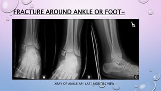 FRACTURE AROUND ANKLE OR FOOT-
XRAY OF ANKLE AP/ LAT/ MORTISE VIEW
 