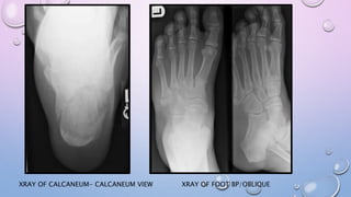 XRAY OF FOOT BP/OBLIQUEXRAY OF CALCANEUM- CALCANEUM VIEW
 