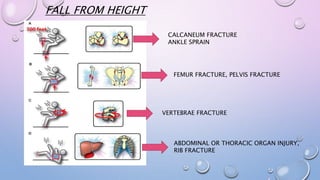FALL FROM HEIGHT
CALCANEUM FRACTURE
ANKLE SPRAIN
FEMUR FRACTURE, PELVIS FRACTURE
VERTEBRAE FRACTURE
ABDOMINAL OR THORACIC ORGAN INJURY,
RIB FRACTURE
 