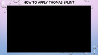 HOW TO APPLY THOMAS SPLINT
 