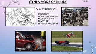 OTHER MODE OF INJURY
DASH BOARD INJURY
• POSTERIOR
DISLOCATION OF HIP
• NECK OF FEMUR
FRACTURE
• IT FEMUR FRACTURE
 
