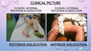 Extremity trauma part 2 | PPTX