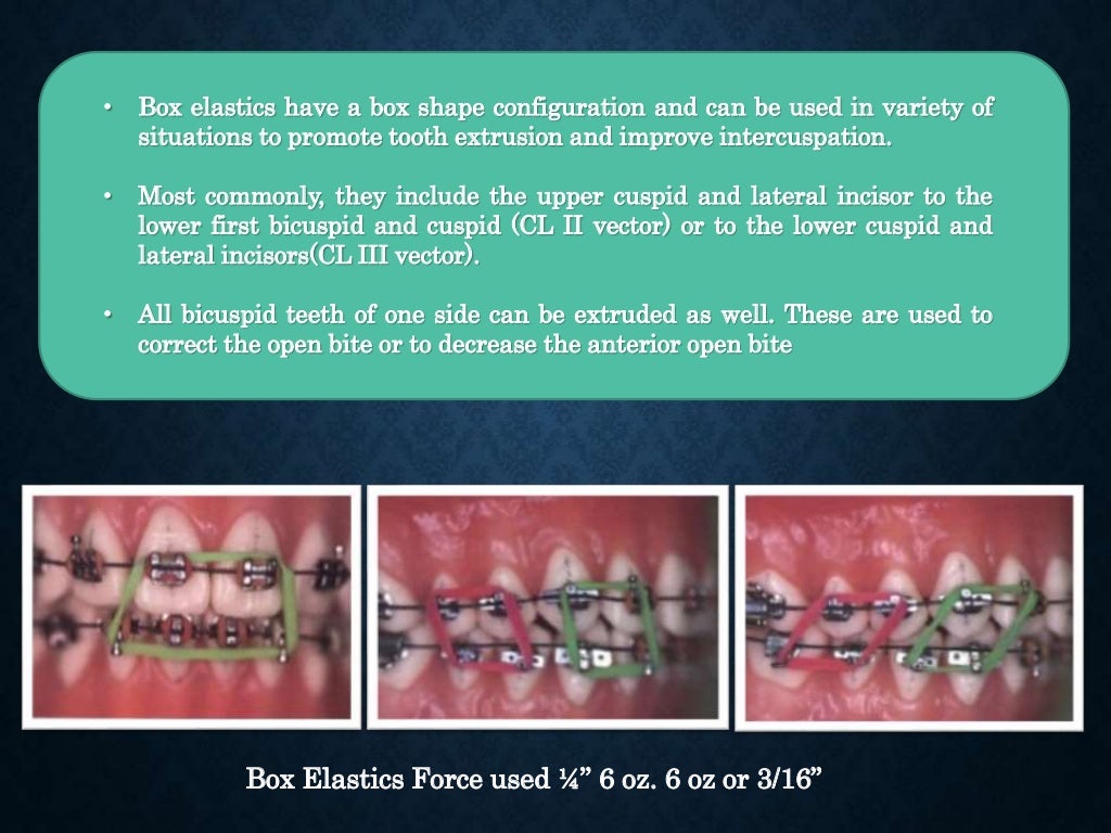 Extrusion by reverse curves archwires by Dr Maher Fouda