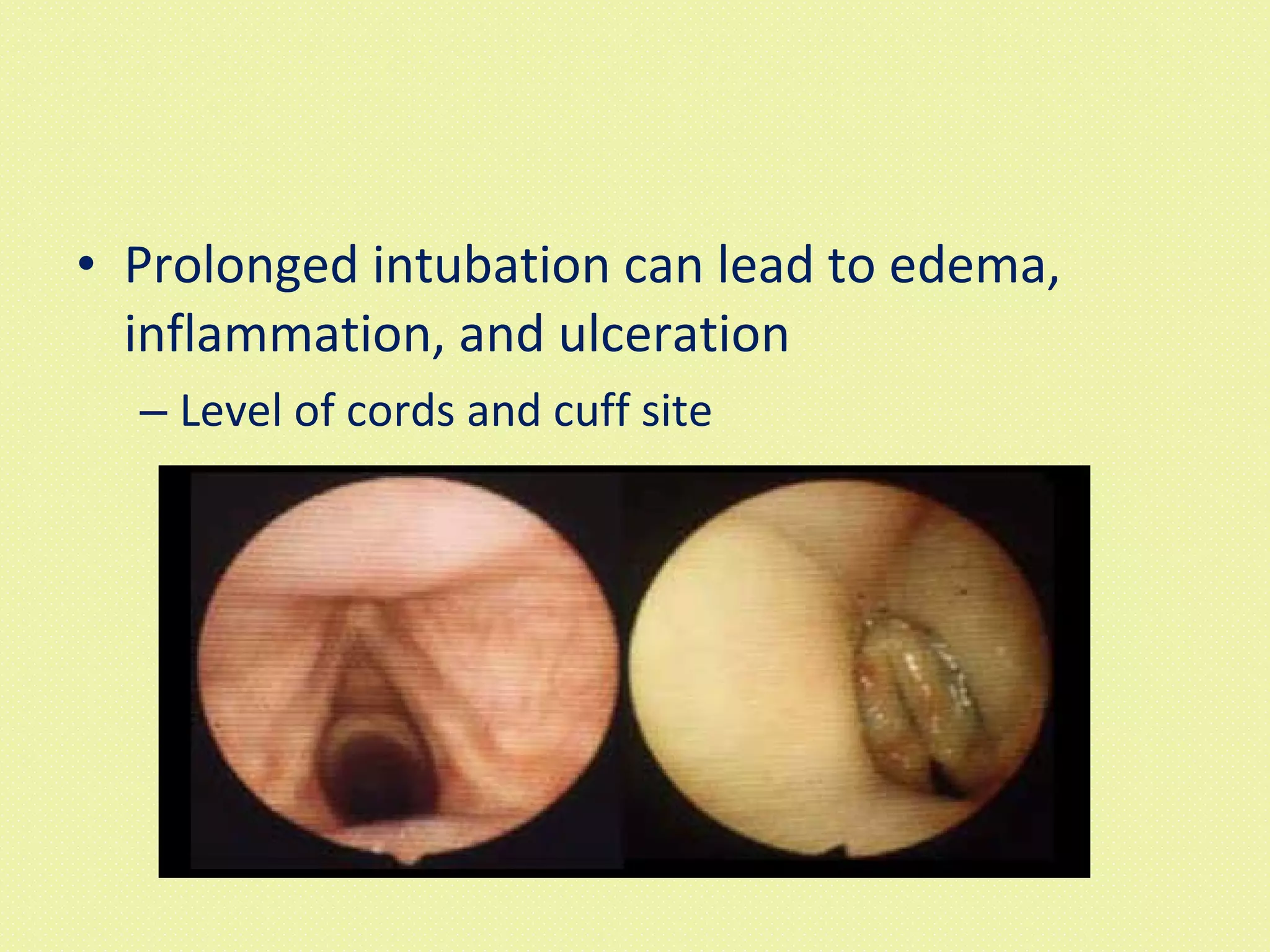 Prolonged intubation can lead to edema, inflammation, and ulceration Level of cords and cuff site 