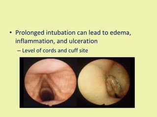 Prolonged intubation can lead to edema, inflammation, and ulceration Level of cords and cuff site 