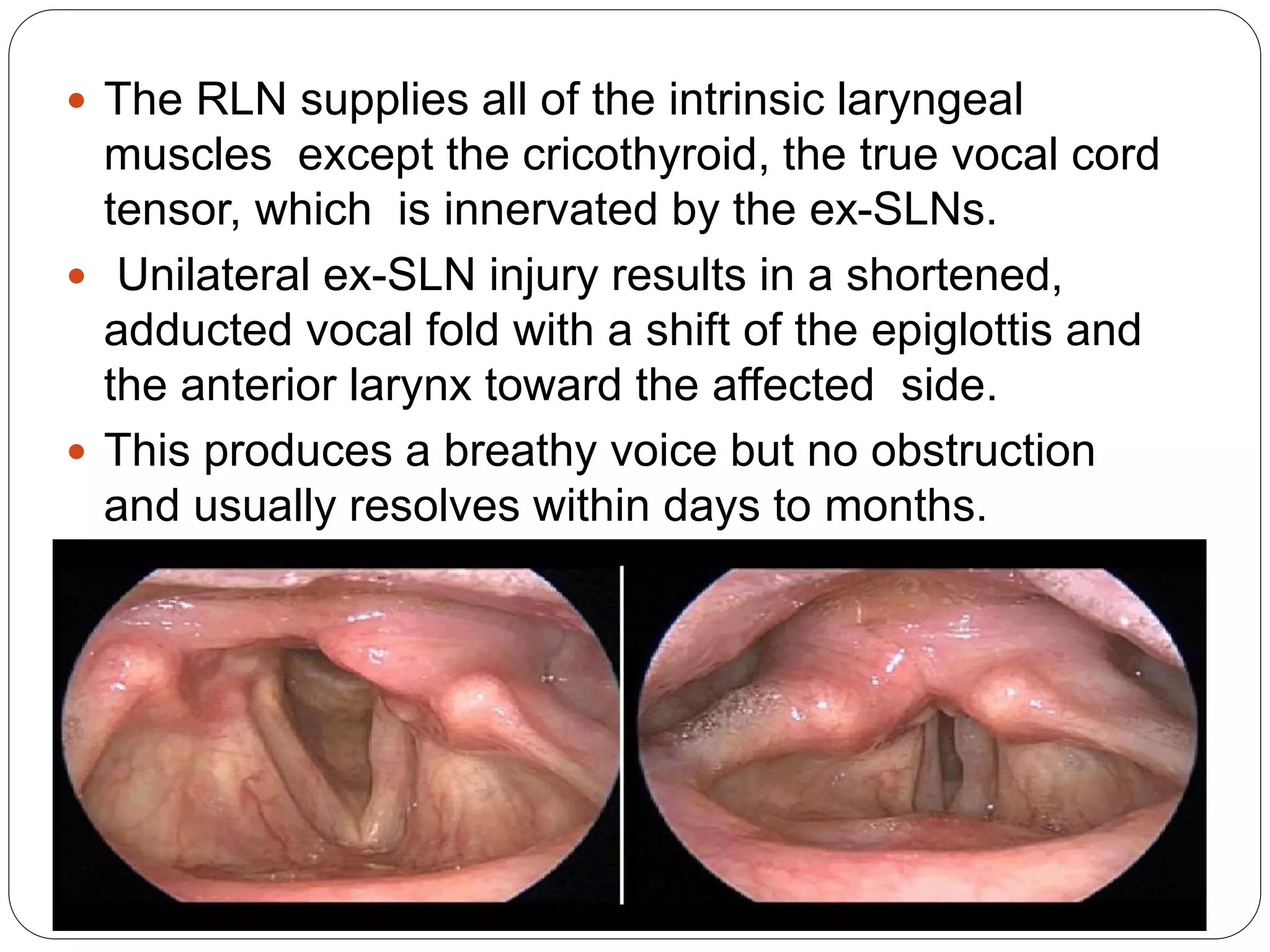  The RLN supplies all of the intrinsic laryngeal
muscles except the cricothyroid, the true vocal cord
tensor, which is innervated by the ex-SLNs.
 Unilateral ex-SLN injury results in a shortened,
adducted vocal fold with a shift of the epiglottis and
the anterior larynx toward the affected side.
 This produces a breathy voice but no obstruction
and usually resolves within days to months.

 