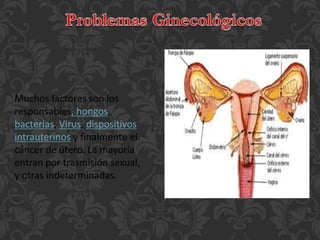 Muchos factores son los 
responsables, hongos, 
bacterias, Virus, dispositivos 
intrauterinos y finalmente el 
cáncer de útero. La mayoría 
entran por trasmisión sexual, 
y otras indeterminadas. 
 