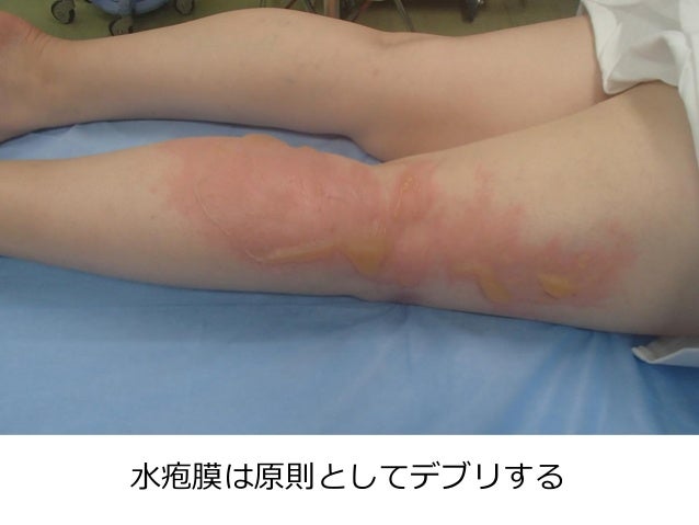 滲出液の流れを意識する 滲出液の流れを意識する