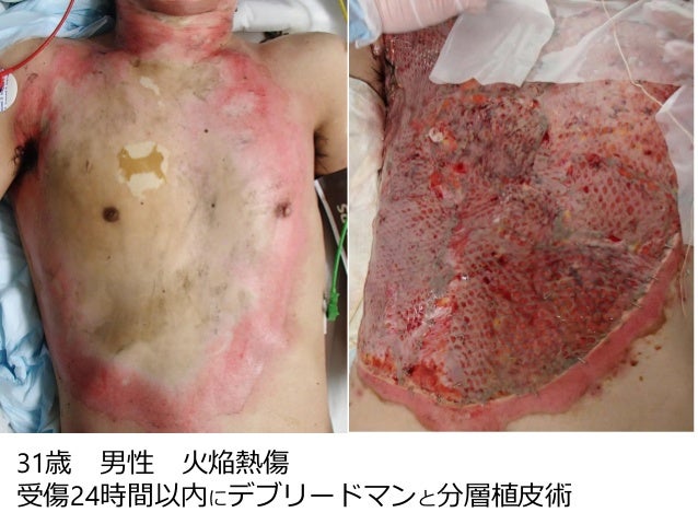 滲出液の流れを意識する 滲出液の流れを意識する