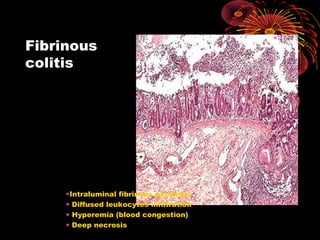Fibrinous 
colitis 
•Intraluminal fibrinous exudates 
• Diffused leukocytes infiltration 
• Hyperemia (blood congestion) 
• Deep necrosis 
 