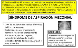 18. Recién nacido de 42 semanas, producto de parto vaginal, distocia por sufrimiento
fetal agudo, con líquido amniótico meconial. APGAR: 6 al minuto 1 y 8 al minuto 5,
recibió ventilación por máscara. A las 2 horas de vida, reportan taquipnea, Sat O2:
70%, tiraje subcostal y cianosis. Rx tórax: infiltrado pulmonar en “parches”. ¿Cuál es el
diagnóstico probable? Rpta: Síndrome de aspiración meconial
SÍNDROME DE ASPIRACIÓN MECONIAL
Desde normal hasta imágenes de
infiltrado grueso “en parches”,
cotonoso con zonas de
irregularidad, atrapamiento de
aire y sobre distensión pulmonar
RADIOLÓGIA
• 10% de los partos con líquido amniótico
teñido por meconio.
• factores de riesgo: embarazo de
término, retardo en el crecimiento
intrauterino, cesárea urgente,
sufrimiento fetal agudo, líquido
amniótico teñido de meconio, APGAR <
de 4 al minuto.
 